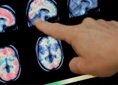 محققان: ابتلای شدید به کرونا مغز را 20 سال پیر می نماید